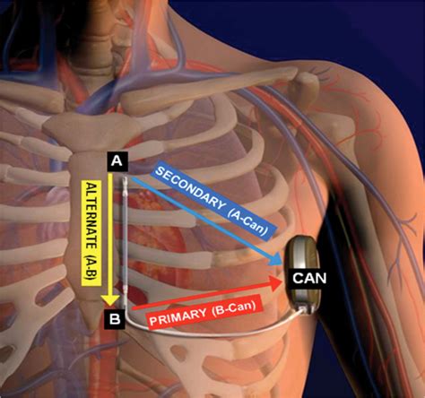 subcutaneous icd implant procedure.